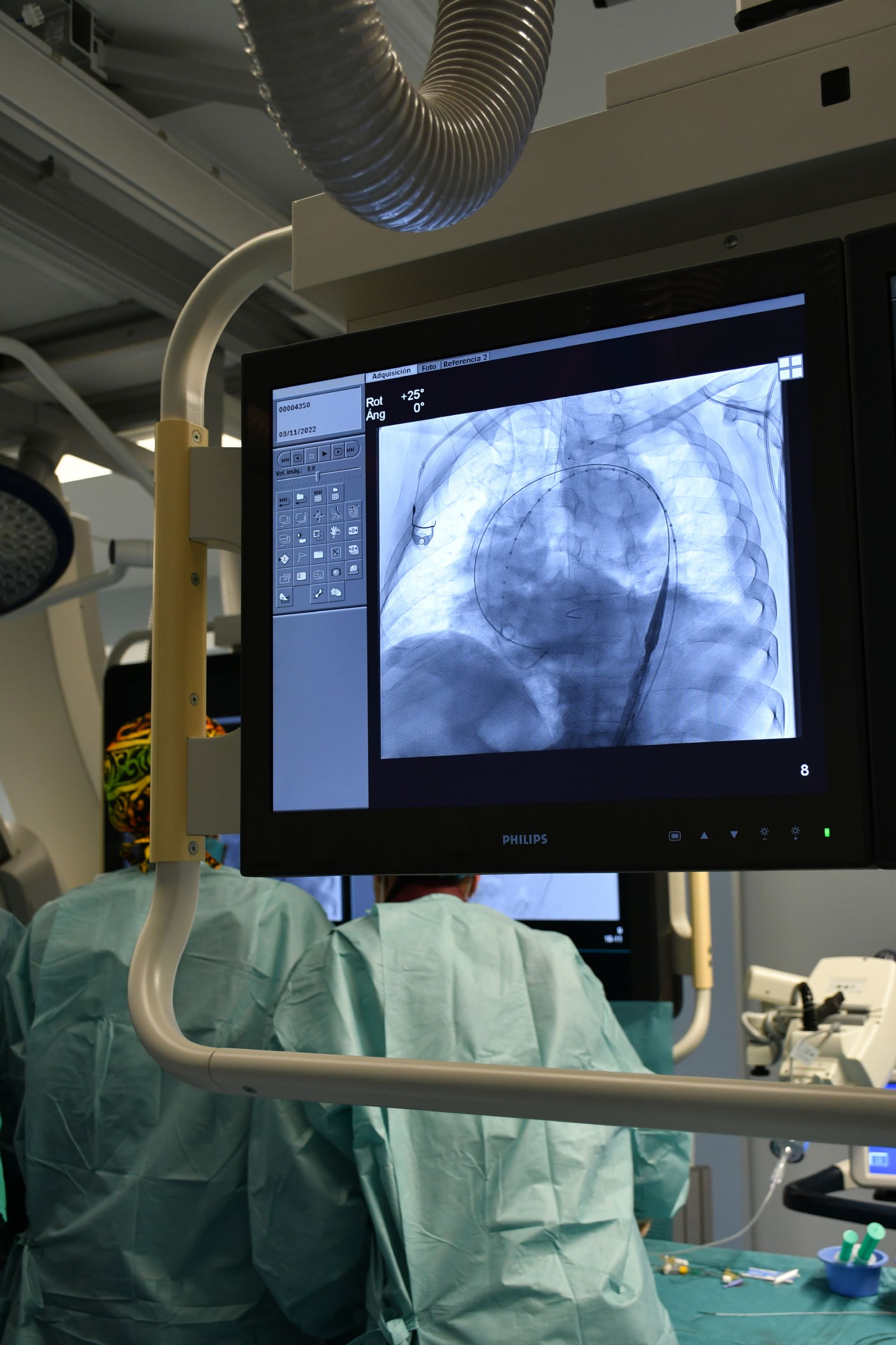 El Centro Mdico implanta por primera vez una endoprtesis de doble rama para una aneurisma de arco artico