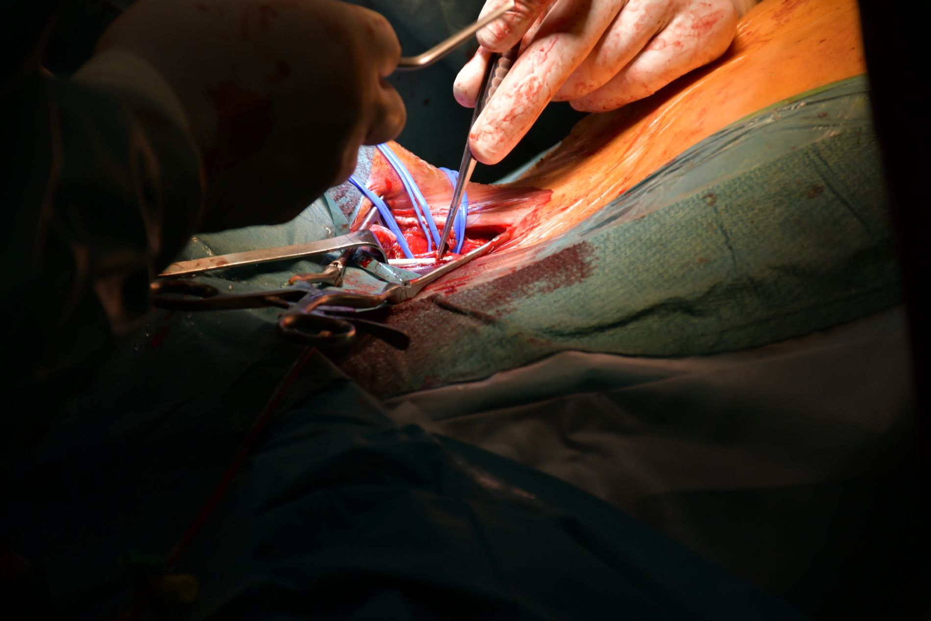 El Centro Mdico implanta por primera vez una endoprtesis de doble rama para una aneurisma de arco artico