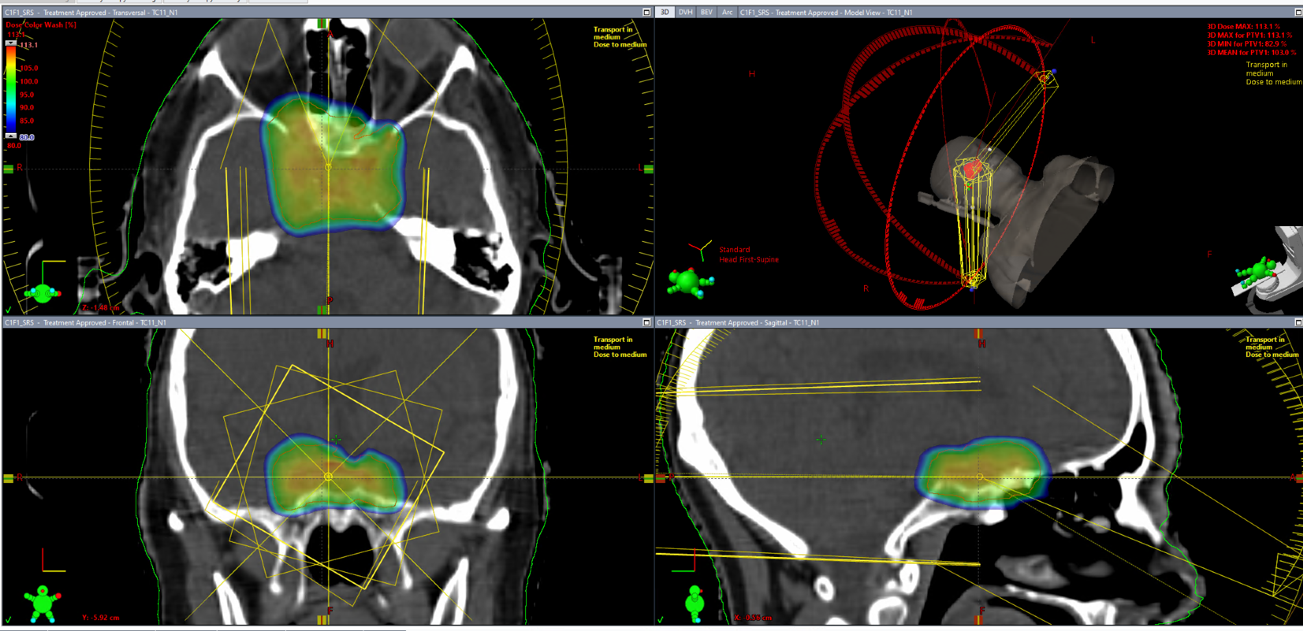 Tratamiento de adenoma hipofisario