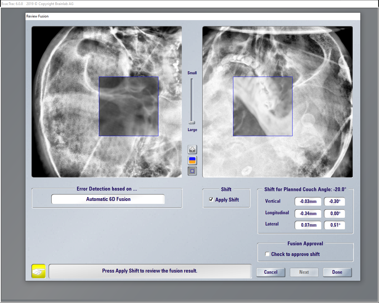 imagen Brainlab ExacTrac