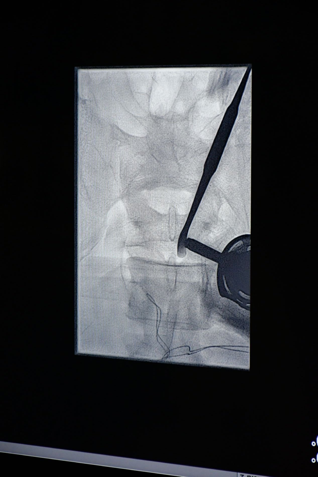 El Hospital Centro Mdico de Asturias realiza la primera ciruga de estenosis de canal mediante endoscopia biportal en Asturias