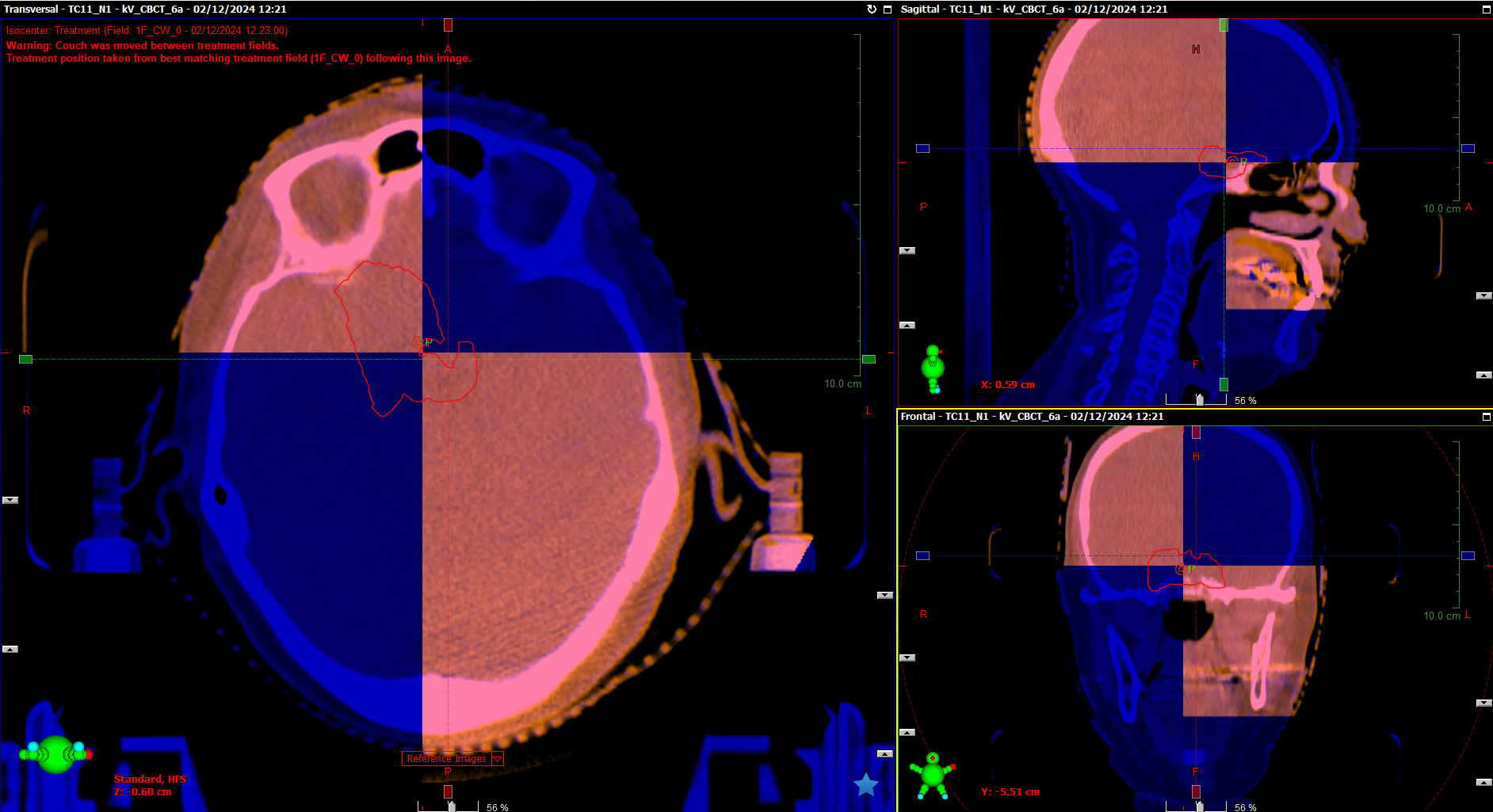 CBCT