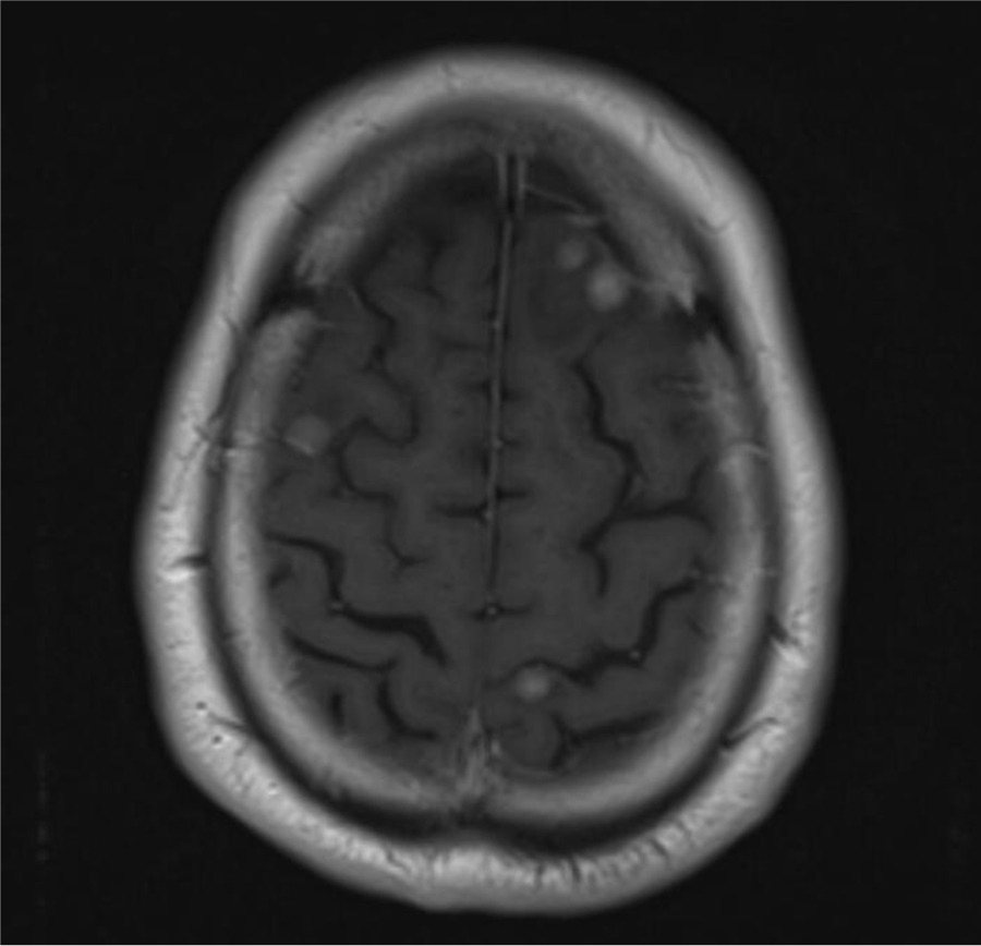 RM cerebral que muestra m�ltiples met�stasis nodulares con edema perilesional.
