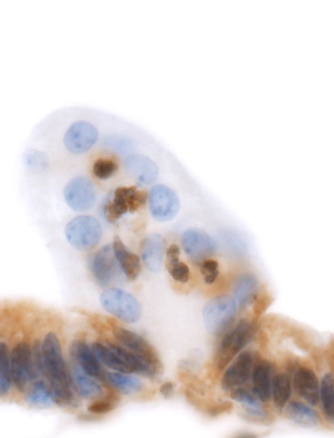 Tumor de pr�stata incipiente surgido en un rat�n modificado gen�ticamente por el Dr. Juan Cadi�anos.