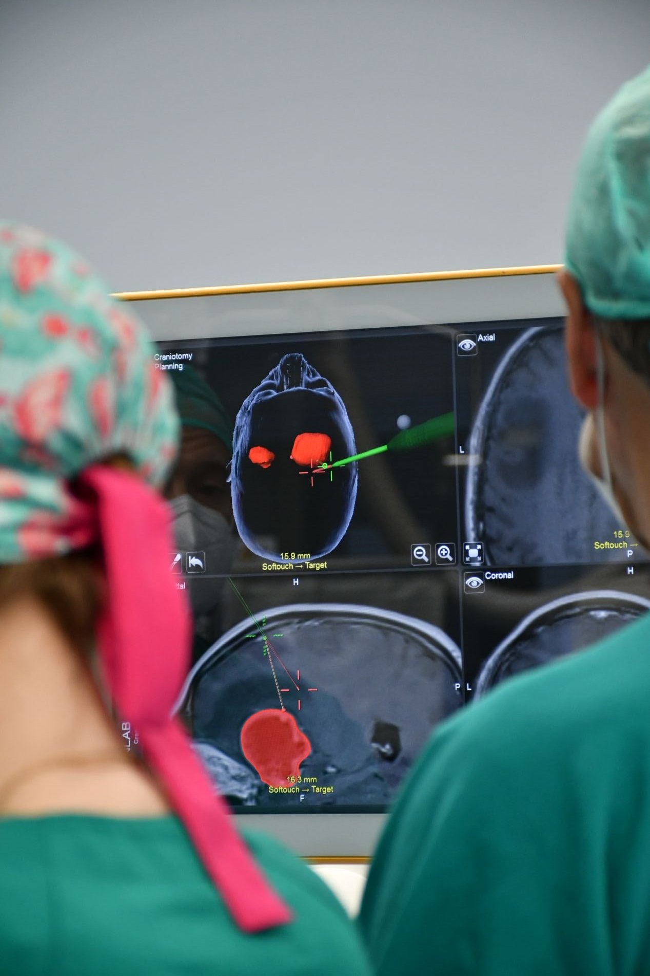 Biopsia cerebral con estereotaxia