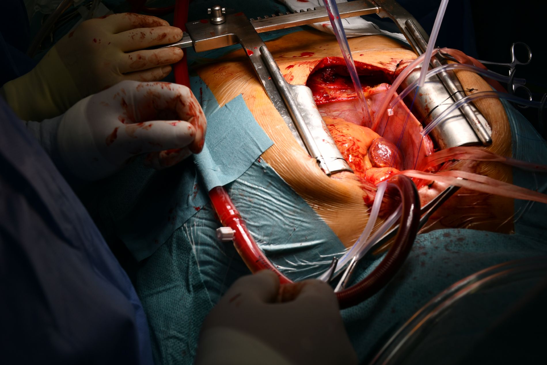 Dentro del corazón, con Cirugía Cardíaca
