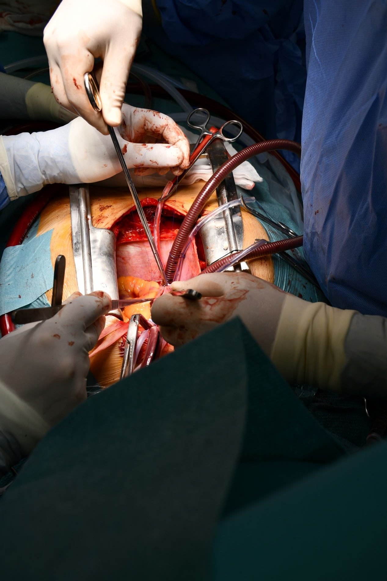 Dentro del corazón, con Cirugía Cardíaca