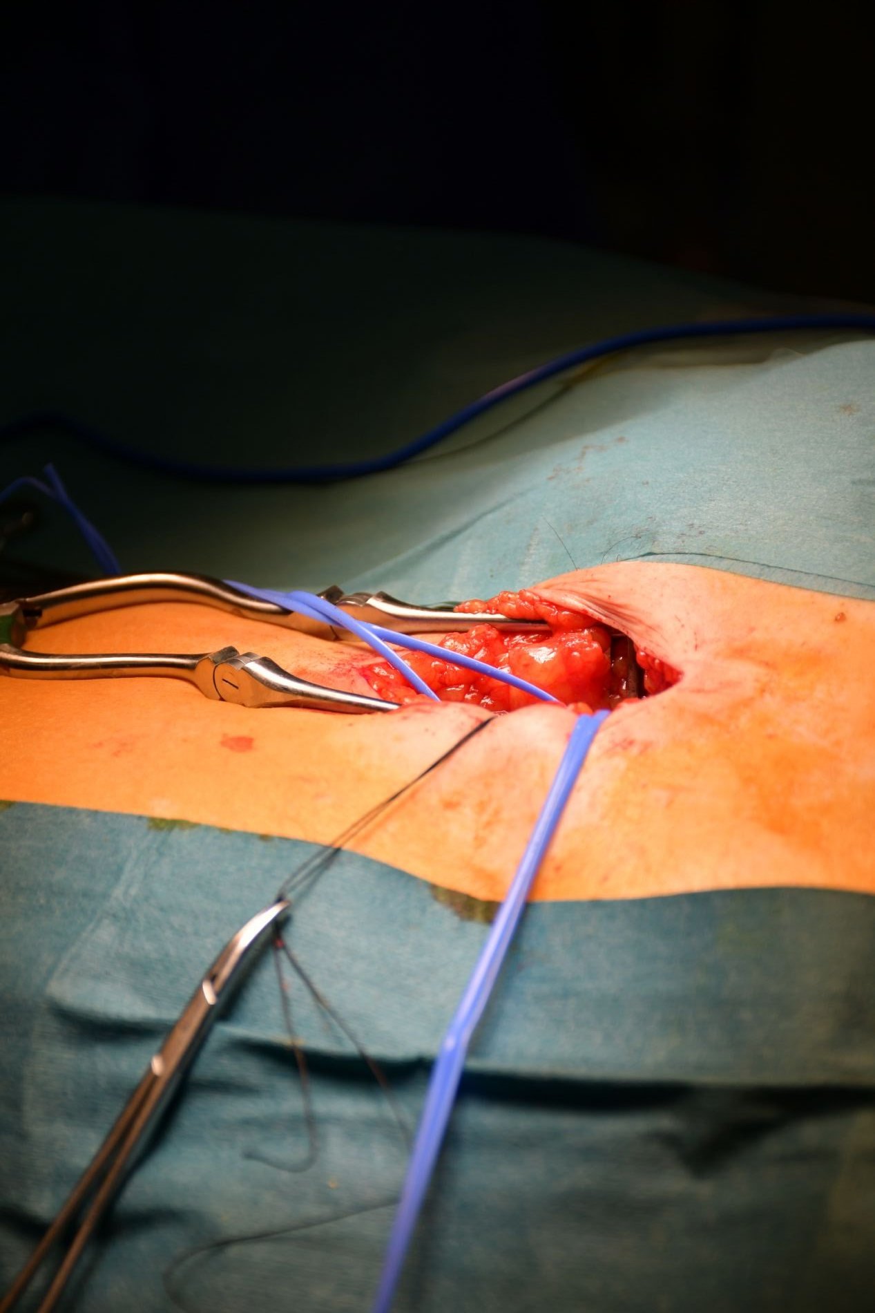 Cirugía endovascular navegada